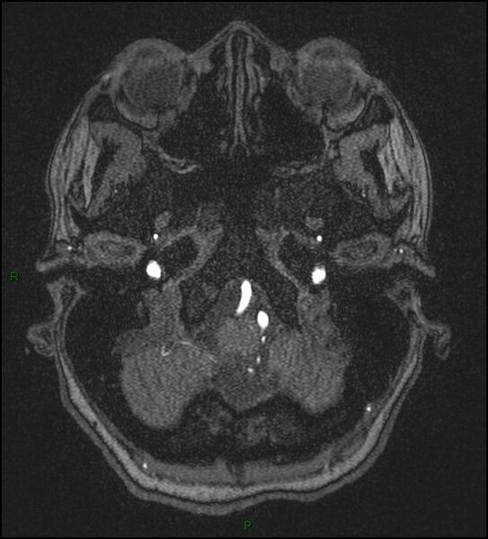 File:Cerebral fat embolism (Radiopaedia 35022-36525 Axial TOF 23).jpg