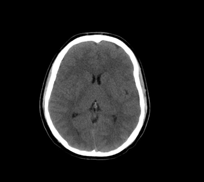 File:Cerebral fat embolism (Radiopaedia 37510-39362 Axial non-contrast 18).jpg