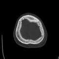 Cerebral hemorrhagic contusions (Radiopaedia 23145-23188 Axial bone window 52).jpg