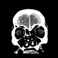 Cerebral hemorrhagic contusions (Radiopaedia 23145-23188 Coronal non-contrast 8).jpg