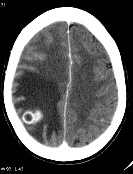 File:Cerebral metastasis - lung cancer (Radiopaedia 5315-7072 Axial C+ delayed 7).jpg