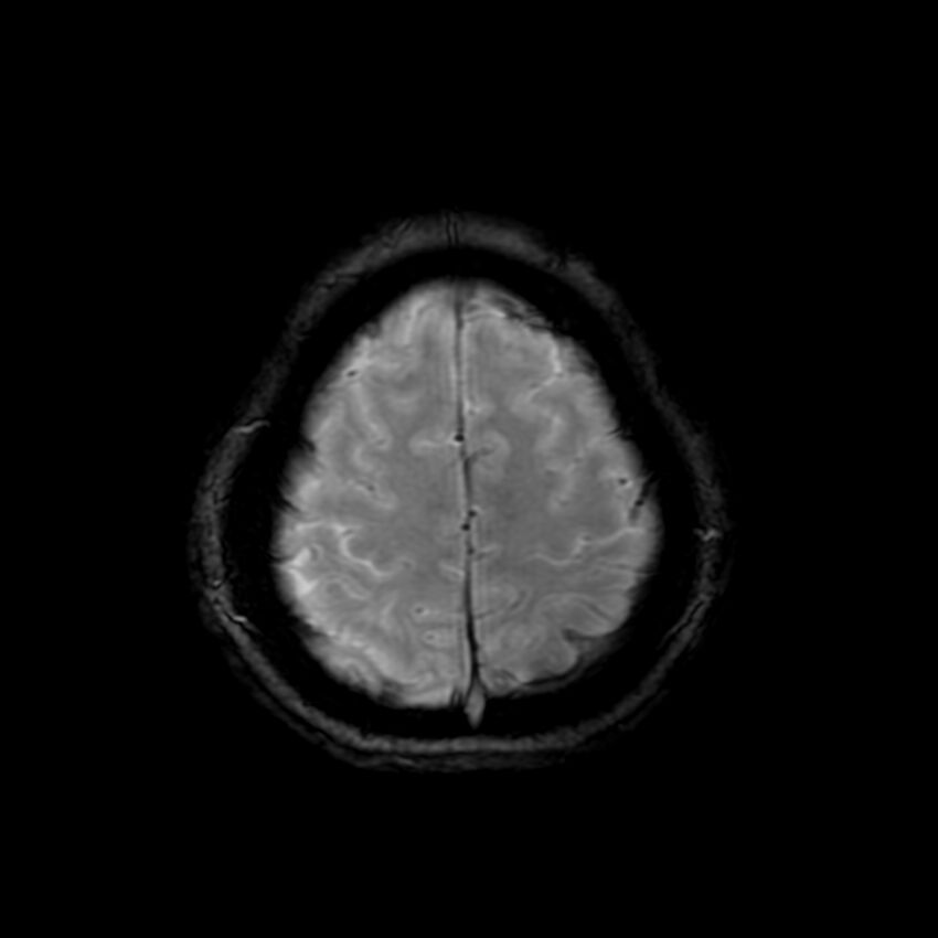 Cerebral paragonimiasis (Radiopaedia 73473-84238 Axial SWI 58).jpg