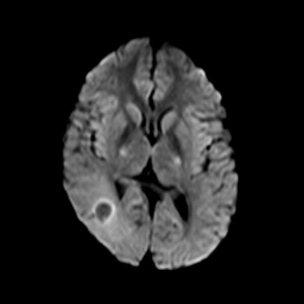 File:Cerebral tuberculoma (Radiopaedia 41152-43932 Axial DWI 11).jpg