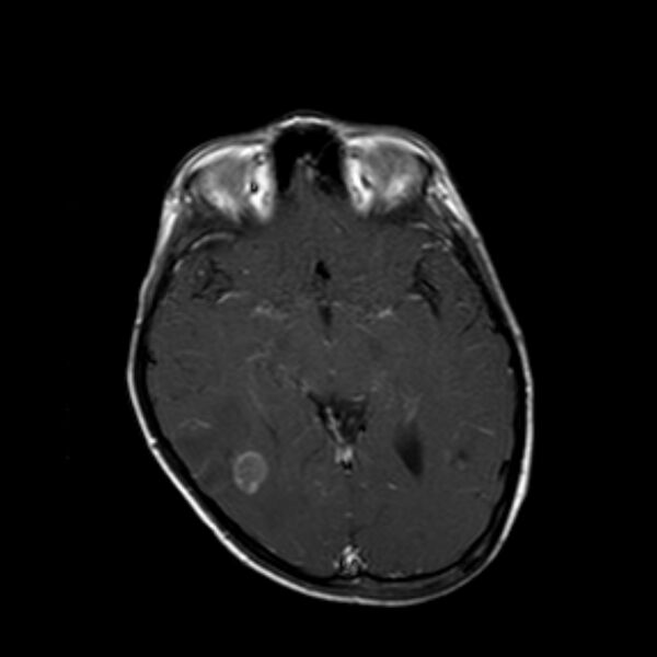 File:Cerebral tuberculoma (Radiopaedia 41152-43932 Axial T1 C+ 10).jpg