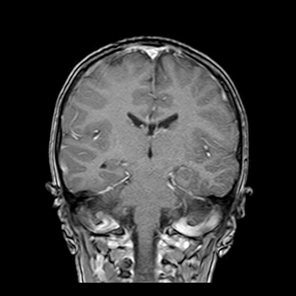 File:Cerebral tuberculoma (Radiopaedia 41152-43932 Coronal T1 C+ 11).jpg