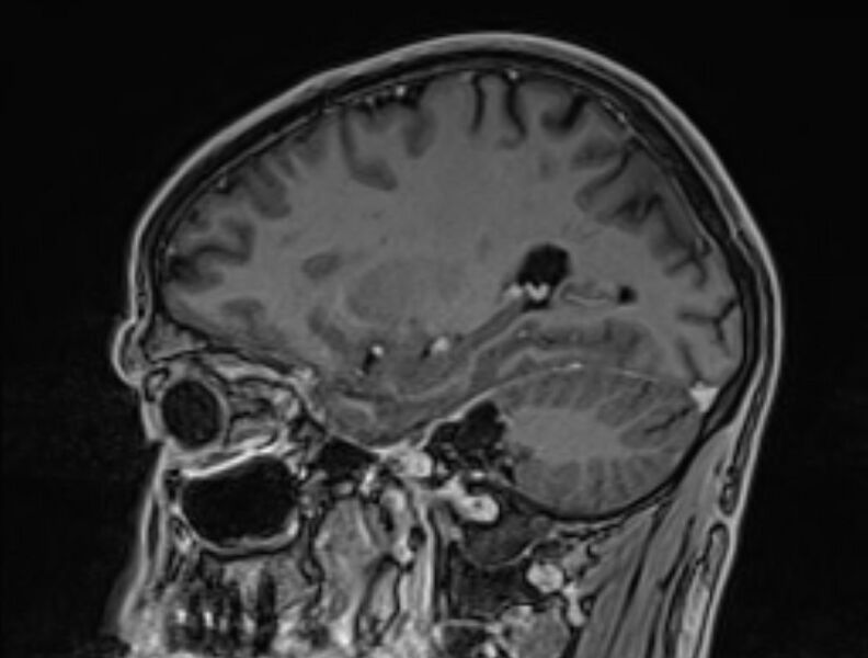 File:Cerebral venous thrombosis (Radiopaedia 71207-81504 Sagittal T1 C+ 19).jpg