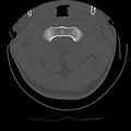 Cervical flexion teardrop fracture with cord hemorrhage (Radiopaedia 32497-33454 Axial bone window 22).jpg