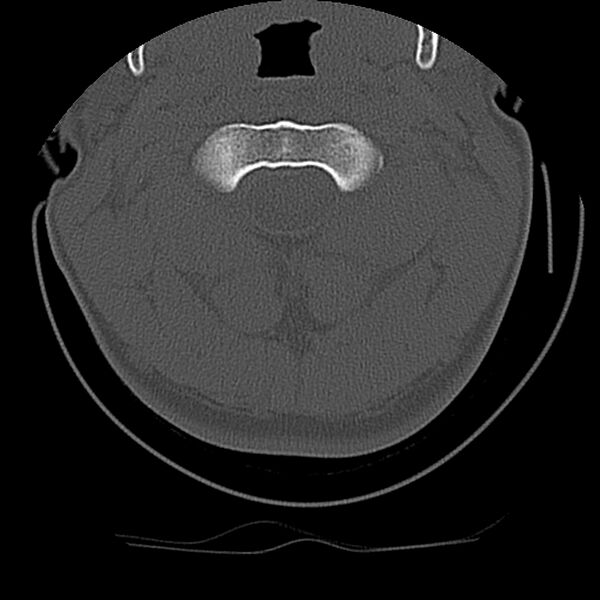 File:Cervical flexion teardrop fracture with cord hemorrhage (Radiopaedia 32497-33454 Axial bone window 22).jpg