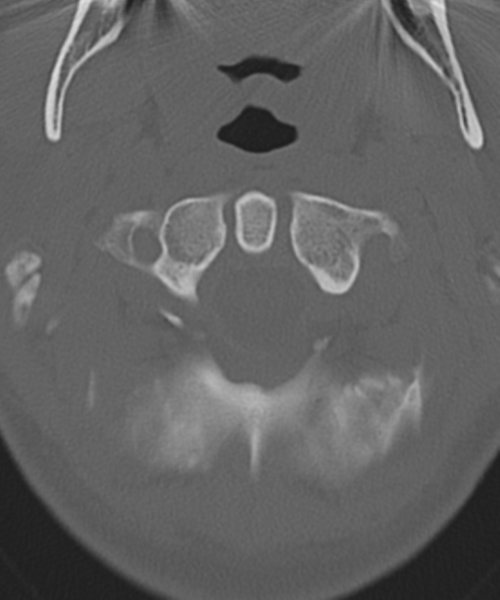 File:Cervical intercalary bone (Radiopaedia 35211-36748 Axial bone window 14).png
