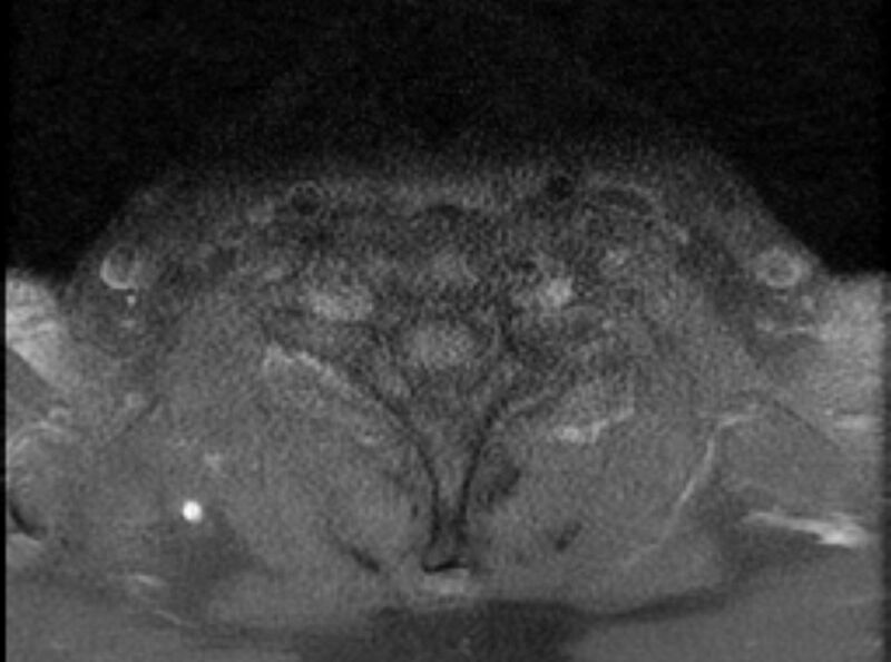 File:Cervical schwannoma (Radiopaedia 72399-82934 Axial T1 C+ fat sat 19).jpg