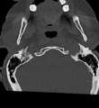 Cervical spine ACDF loosening (Radiopaedia 48998-54070 Axial bone window 7).png