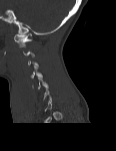 File:Cervical spine posterior ligamentous complex rupture (Radiopaedia 63486-72101 Sagittal bone window 23).jpg