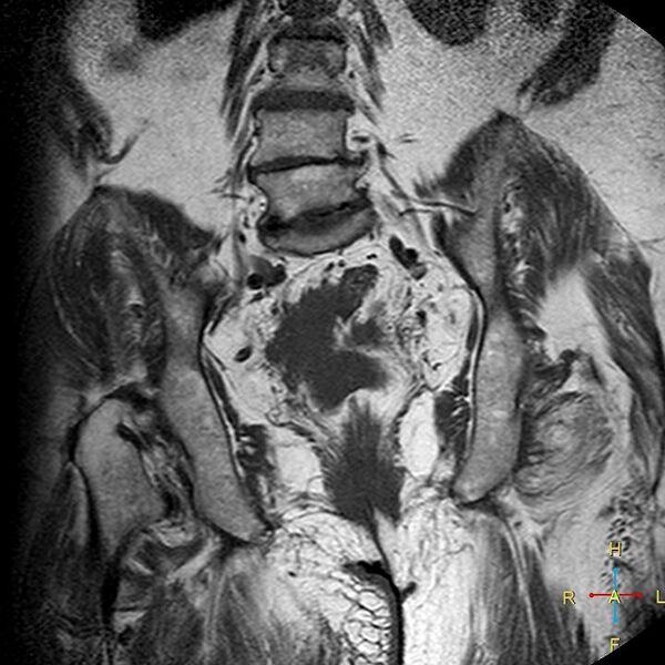 File:Cervical stump squamous cell carcinoma (Radiopaedia 48049-52858 Coronal T1 13).jpg
