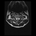 Cervical vertebrae metastasis (Radiopaedia 78814-91667 Axial T2 20).png
