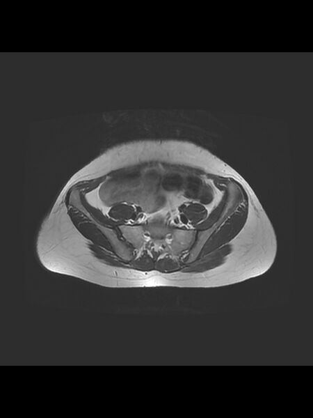 File:Cesarean section scar endometrioma (Radiopaedia 56569-63297 Axial T2 4).jpg