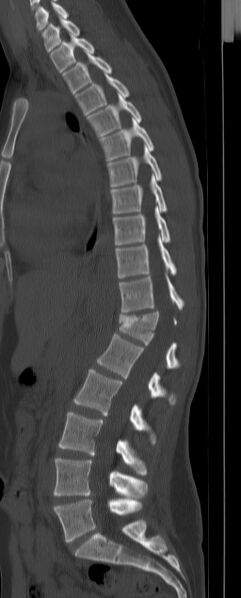 File:Chance fracture (Radiopaedia 45345-49372 Sagittal bone window 13).jpg
