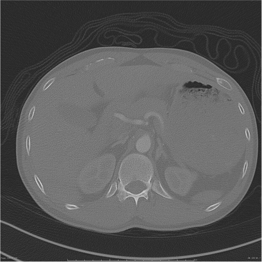 Chest and abdomen multi-trauma (Radiopaedia 26294-26425 bone window 106).jpg
