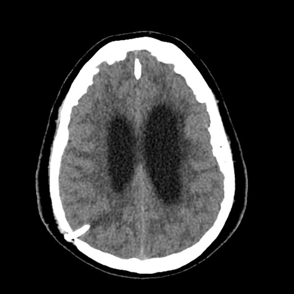 File:Chiasmatic-hypothalamic juvenile pilocytic astrocytoma (Radiopaedia 78533-91237 Axial non-contrast 41).jpg