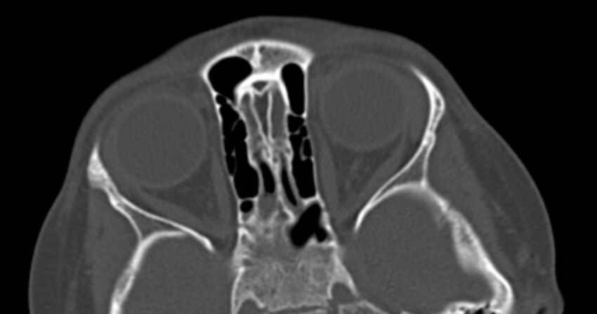 Choanal atresia (Radiopaedia 51295-56972 Axial bone window 48).jpg