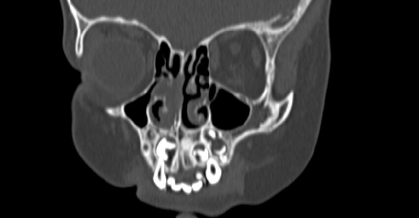 Choanal atresia (Radiopaedia 51295-56972 Coronal bone window 21).jpg