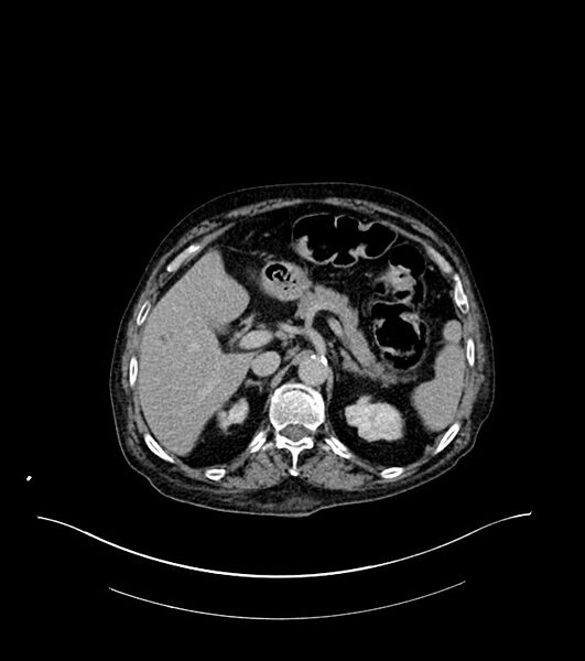 File:Cholangiocarcinoma with cerebral metastases (Radiopaedia 83519-98629 Axial C+ delayed 30).jpg