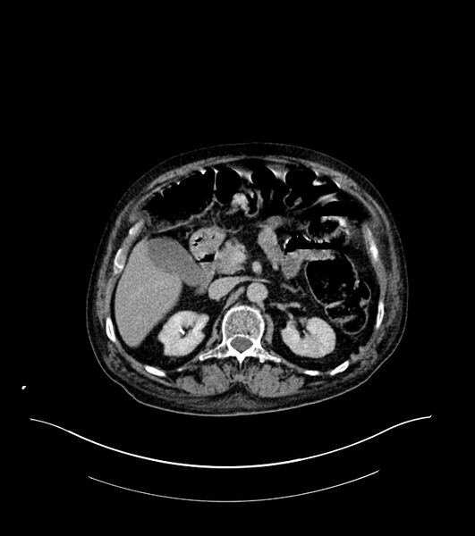 File:Cholangiocarcinoma with cerebral metastases (Radiopaedia 83519-98629 Axial C+ delayed 39).jpg