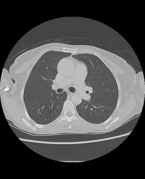 File:Chondrosarcoma (Radiopaedia 79427-92532 Axial lung window 24).jpg