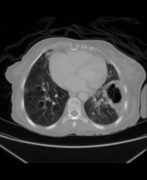 File:Chondrosarcoma (Radiopaedia 79427-92535 Axial lung window 36).jpg