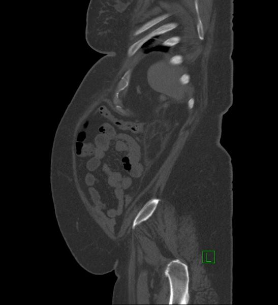 File:Chromophobe renal cell carcinoma (Radiopaedia 84239-99519 Sagittal bone window 14).jpg