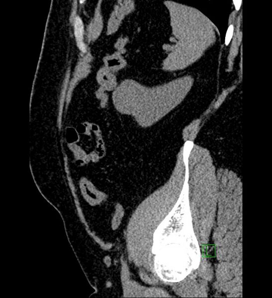 File:Chromophobe renal cell carcinoma (Radiopaedia 84286-99573 C 33).jpg