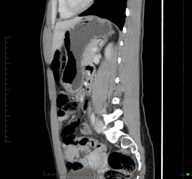 File:Chronic abscess due to "dropped" appendicoliths following appendectomy for perforated appendix (Radiopaedia 58805-66344 D 23).jpg