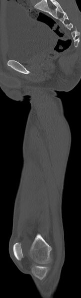 File:Chronic osteomyelitis (with sequestrum) (Radiopaedia 74813-85822 C 61).jpg
