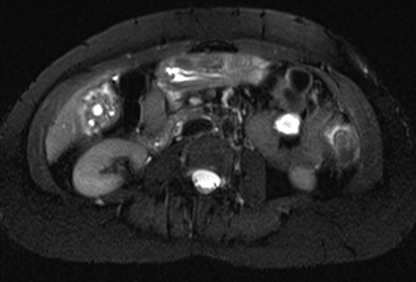 Chronic pancreatitis - pancreatic duct calculi (Radiopaedia 71818-82250 Axial T2 fat sat 40).jpg