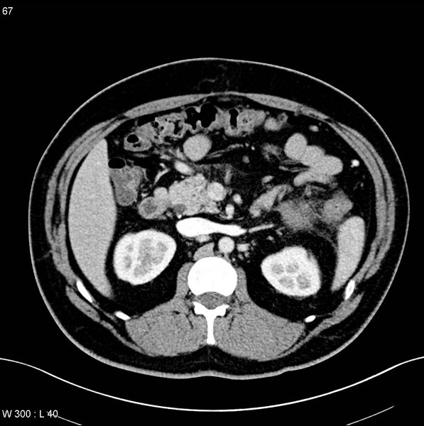 File:Chronic pancreatitis and pseudocysts (Radiopaedia 6724-7935 B 12).jpg