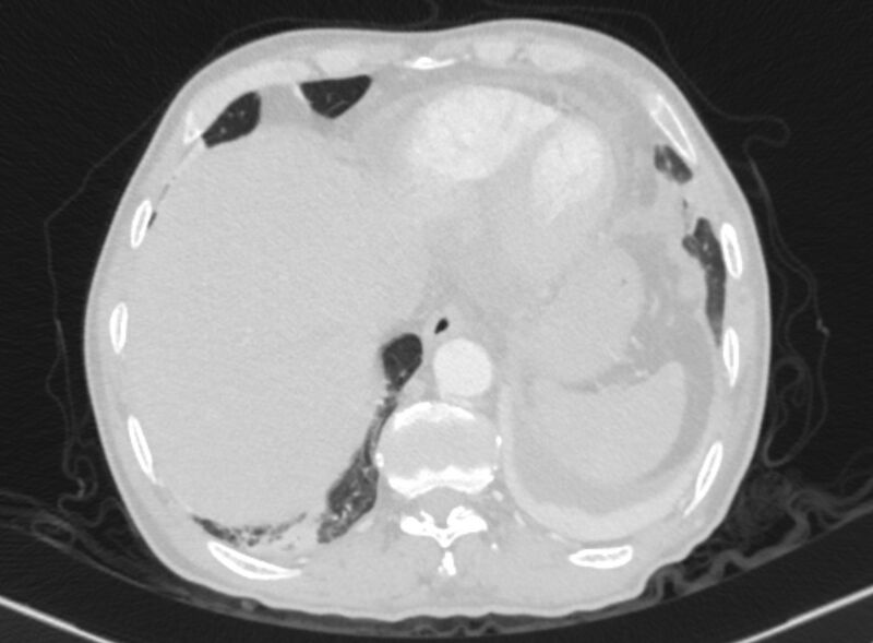File:Chronic pulmonary embolism with bubbly consolidation (Radiopaedia 91248-108850 Axial lung window 131).jpg