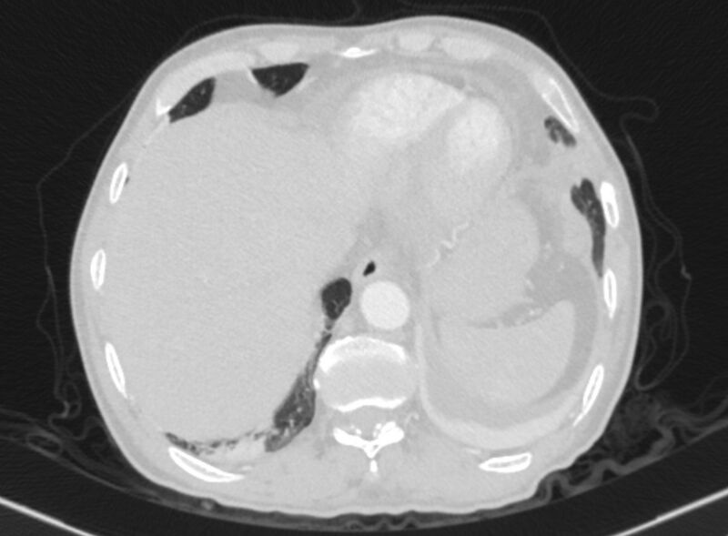 File:Chronic pulmonary embolism with bubbly consolidation (Radiopaedia 91248-108850 Axial lung window 132).jpg