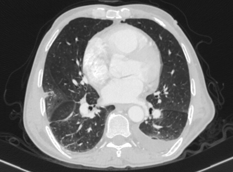File:Chronic pulmonary embolism with bubbly consolidation (Radiopaedia 91248-108850 Axial lung window 96).jpg