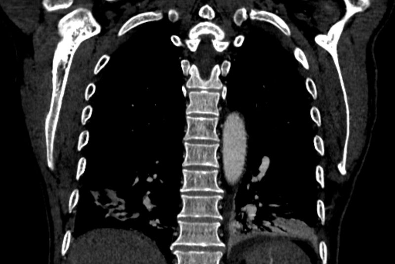 File:Chronic pulmonary embolism with bubbly consolidation (Radiopaedia 91248-108850 B 109).jpg