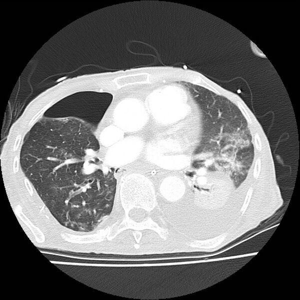 File:Clagett thoracotomy with bronchopleural fistula (Radiopaedia 29192-29587 Axial lung window 26).jpg