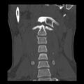 Clay-shoveler fracture (Radiopaedia 22568-22590 Coronal bone window 5).jpg