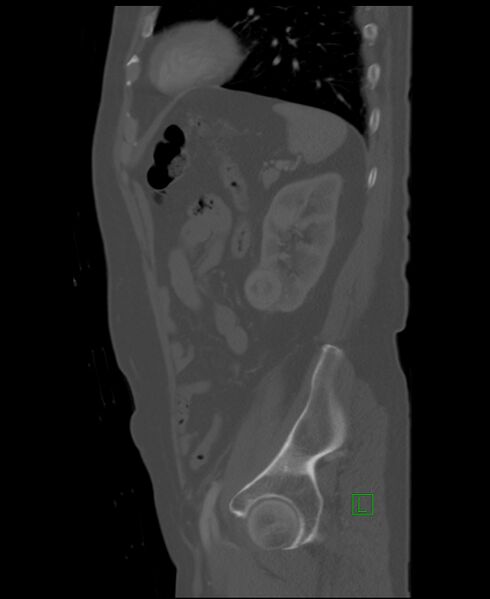 File:Clear cell renal cell carcinoma (Radiopaedia 85006-100539 Sagittal bone window 15).jpg