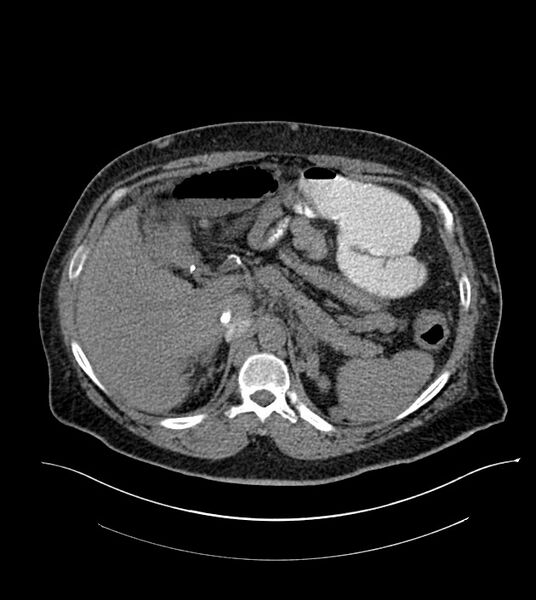 File:Closed-loop small bowel obstruction-internal hernia (Radiopaedia 78439-91096 Axial non-contrast 42).jpg