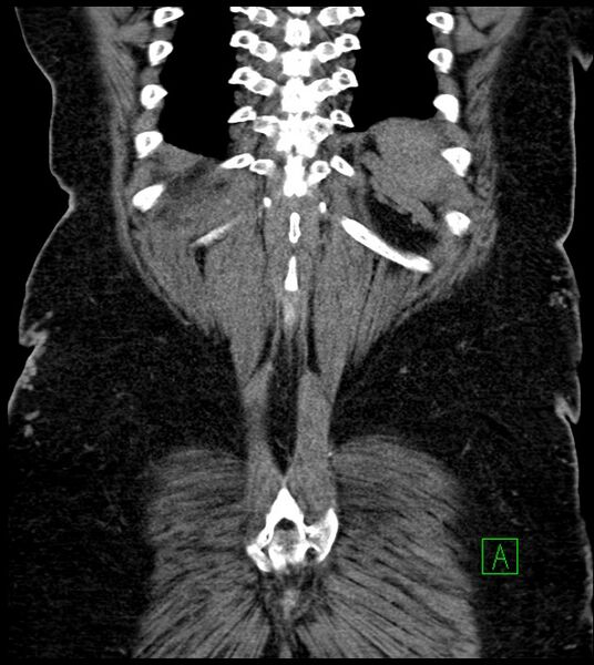File:Closed-loop small bowel obstruction-internal hernia (Radiopaedia 78439-91096 Coronal non-contrast 88).jpg