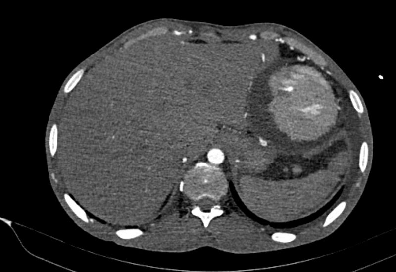 File:Coarctation of aorta with aortic valve stenosis (Radiopaedia 70463-80574 A 214).jpg
