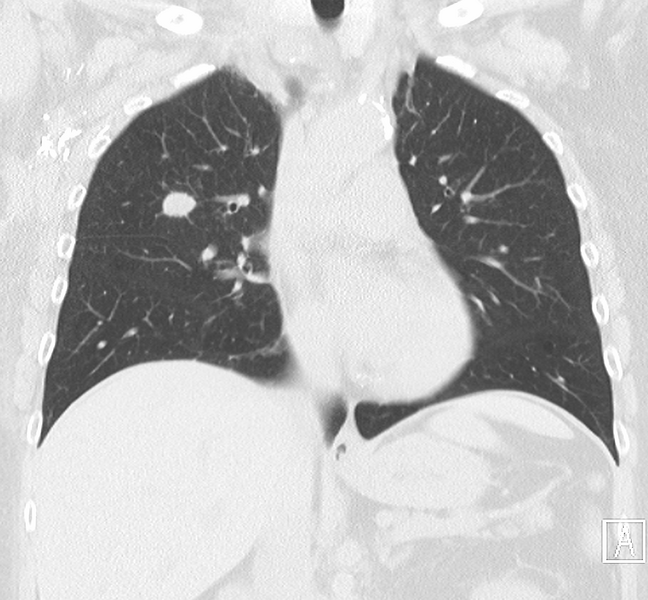 File:Coin lesion - breast cancer metastasis (Radiopaedia 29909-30428 Coronal lung window 1).png