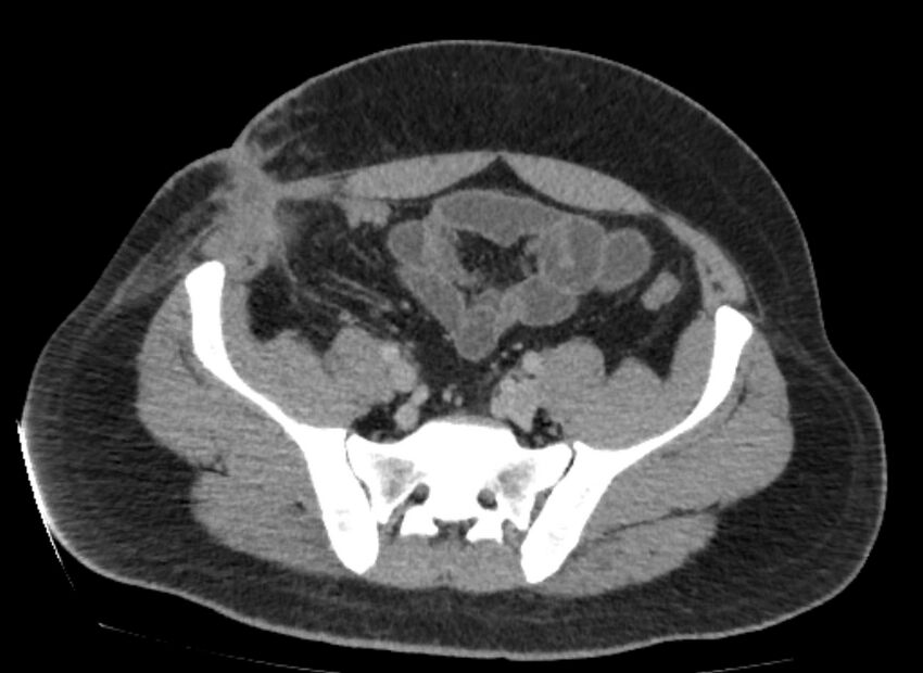 Colocutaneous fistula (Radiopaedia 56401-63062 A 71).jpg