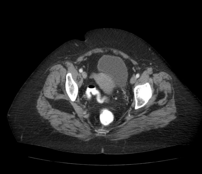 File:Colonic diverticulosis (Radiopaedia 22934-22957 A 66).jpg