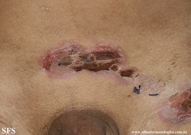 File:Impetigo (Dermatology Atlas 107).jpg