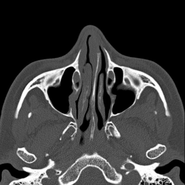 File:Nasal septal perforation (Radiopaedia 25030-25289 Axial bone window 21).jpg