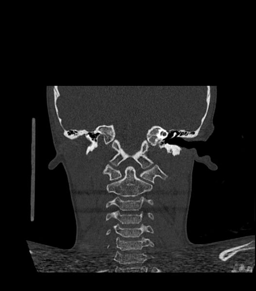 File:Nasoorbitoethmoid fracture (Radiopaedia 90044-107205 Coronal bone window 100).jpg